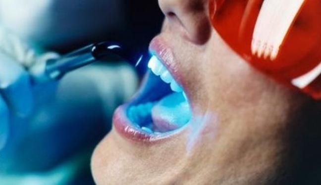 Wybielanie zębów w domu ? fakty i mity